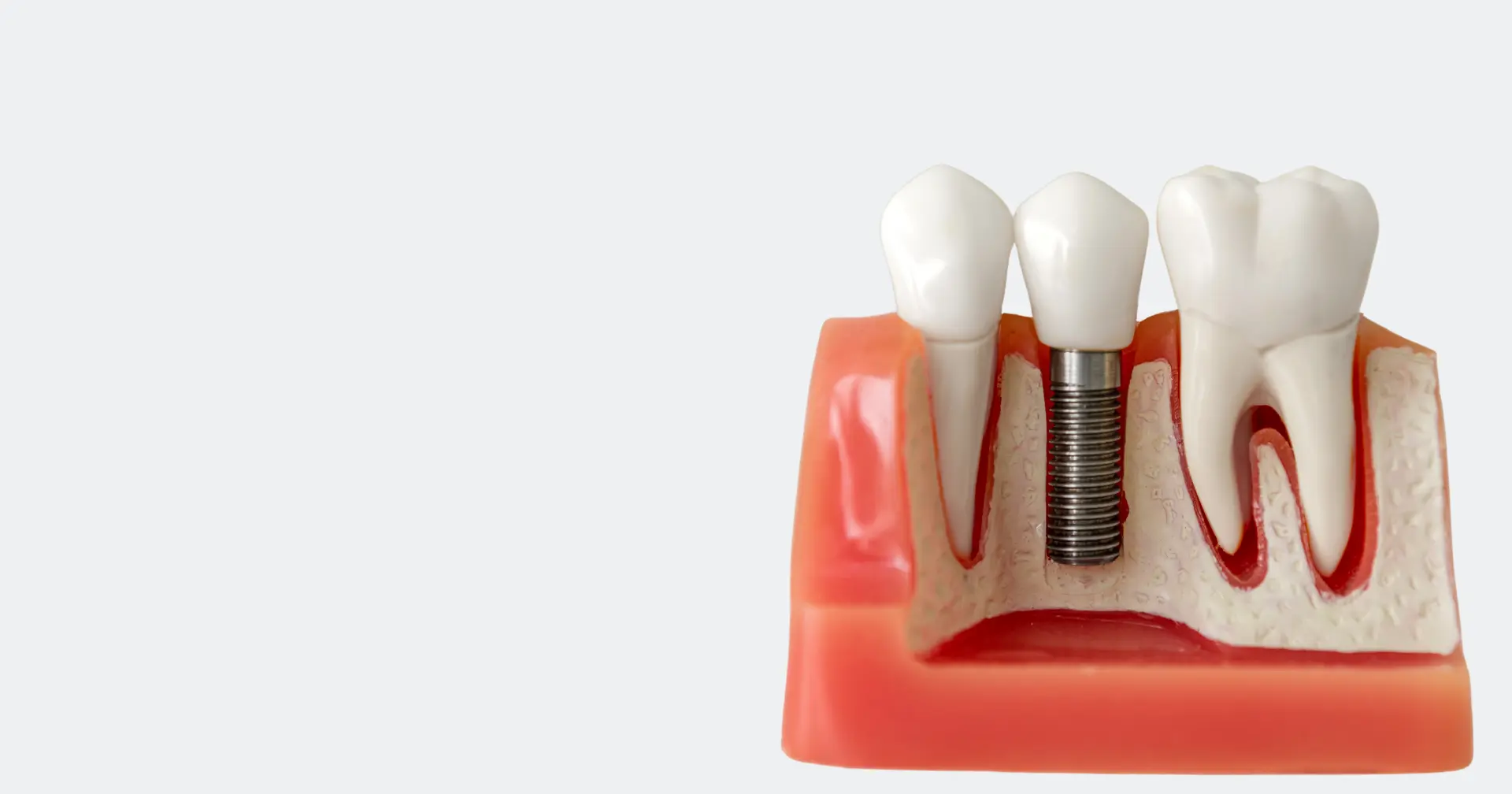 Dental implants kitchener
