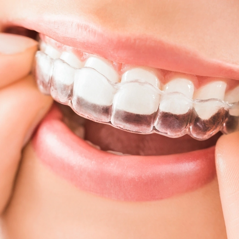 Patient placing a clear orthodontic aligner over their teeth at Walk in the Park Family Dental in Kitchener