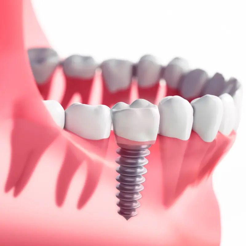 3D illustration of a dental implant replacing a missing tooth