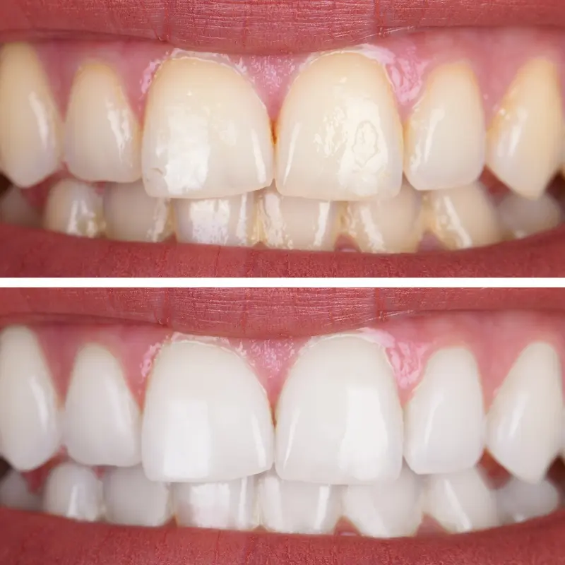 Before and after teeth whitening results showing brighter, whiter teeth at Walk in the Park Family Dental in Kitchener
