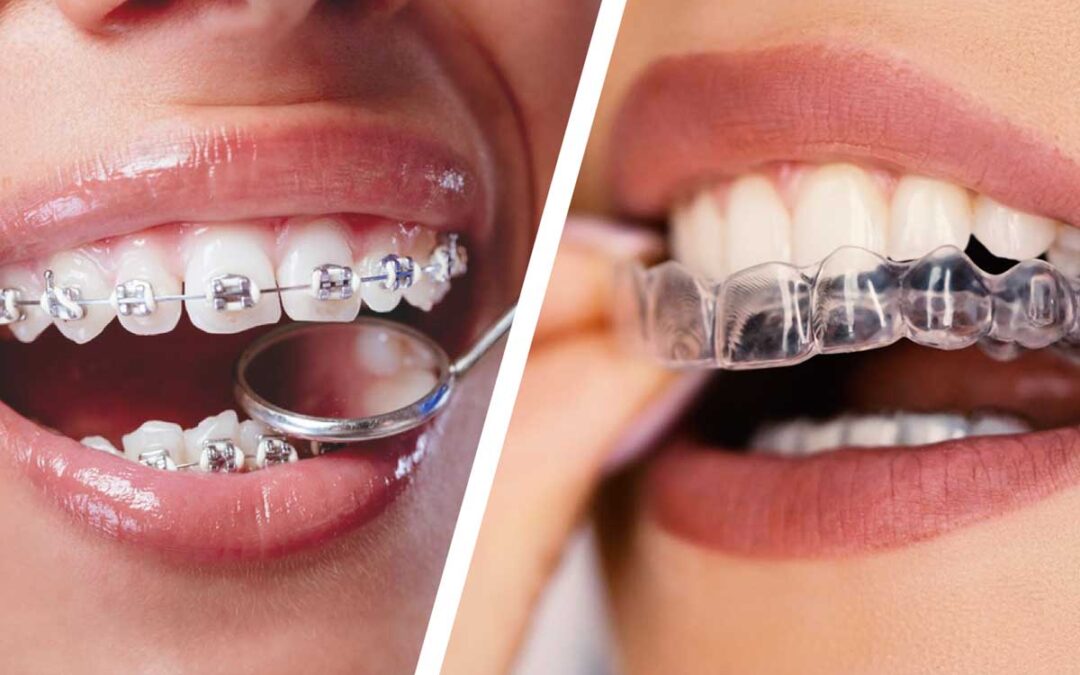 Invisalign vs Braces in Kitchener: How to Choose the Right Treatment for Your Smile