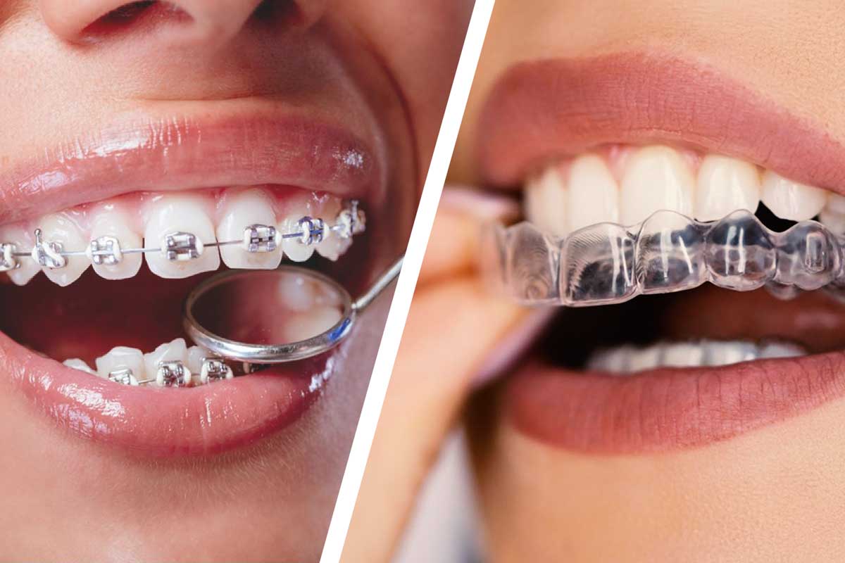 Invisalign and Braces Comparison Close-up comparison of metal braces and clear Invisalign aligners on teeth